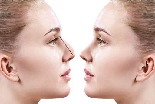 Rhinoplasty 48745845845847