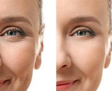 Fat injection 14874854854184185