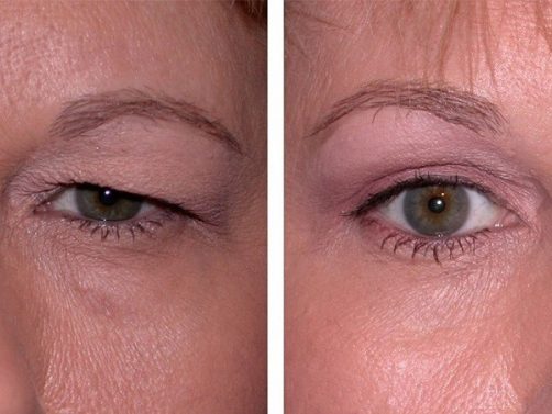 Eyelid 6879678978979